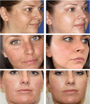 Dr.Hancy Whitening Freckle Cream Remove  Acne Spots Melanin Dark Spots Face Moisturizing Face Skin Care